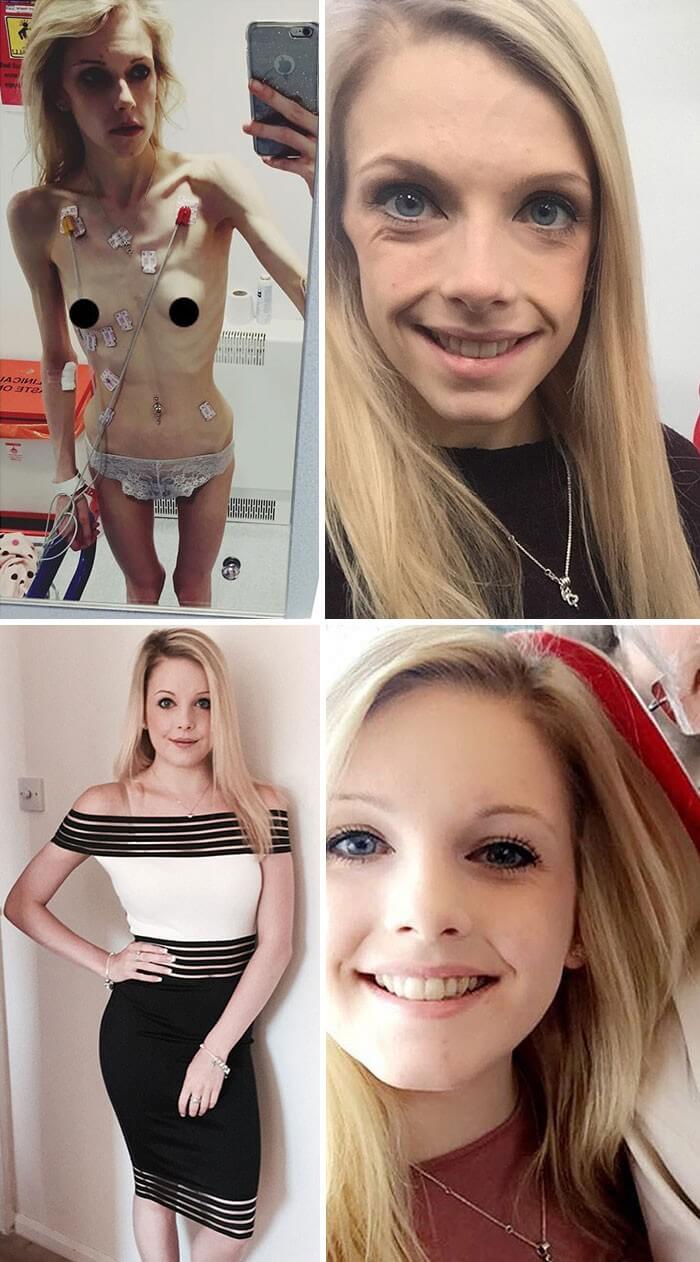 Anorexia Antes e Depois (11)