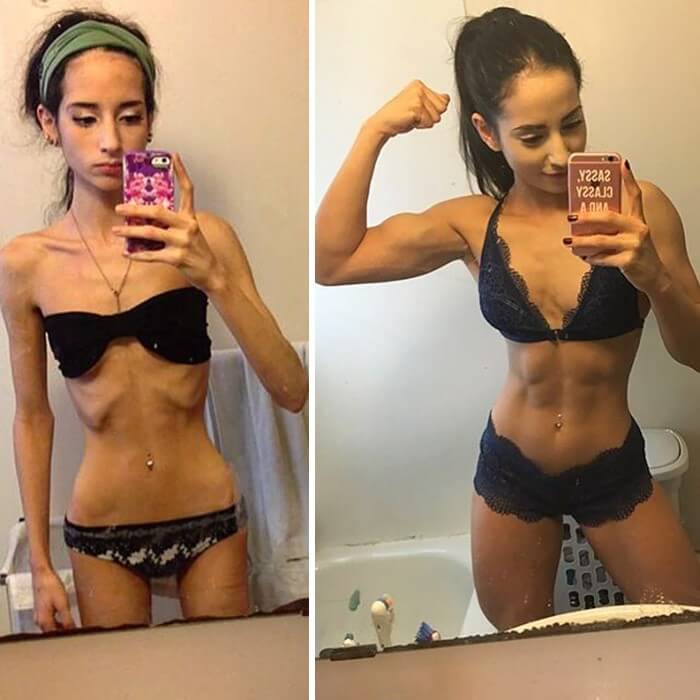 Anorexia Antes e Depois (18)