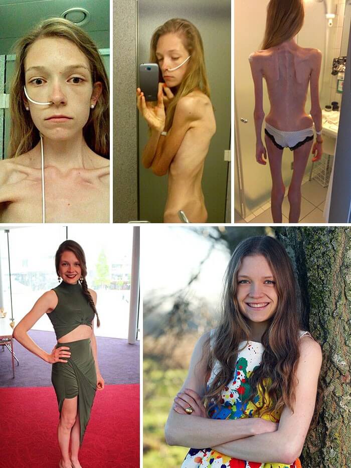 Anorexia Antes e Depois (2)