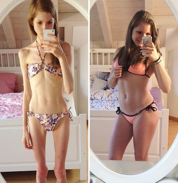 Anorexia Antes e Depois (24)