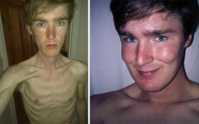 Anorexia Antes e Depois (25)