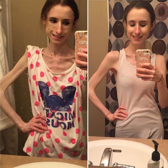 Anorexia Antes e Depois (27)