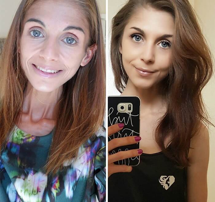 Anorexia Antes e Depois (28)