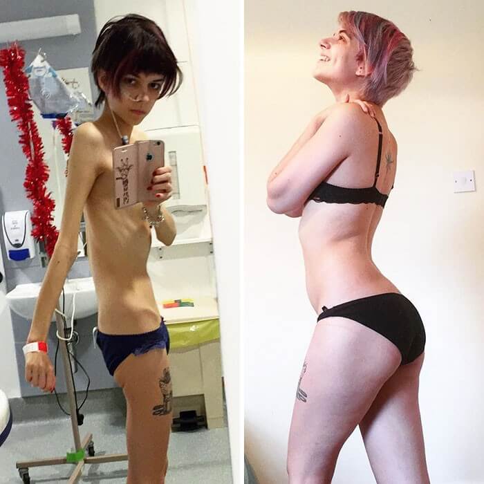 Anorexia Antes e Depois (3)