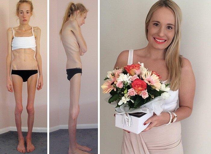 Anorexia Antes e Depois (30)