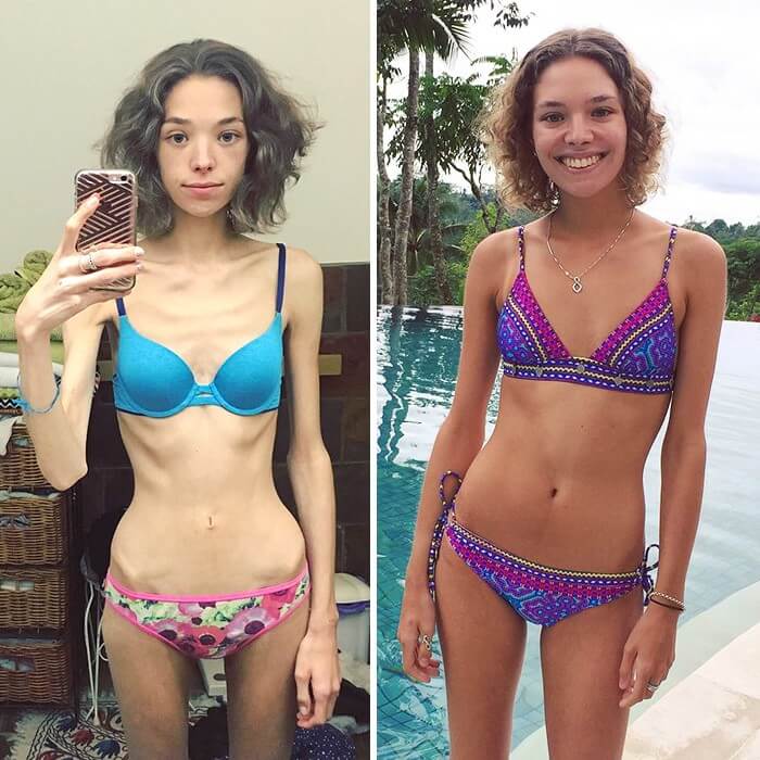 Anorexia Antes e Depois (31)