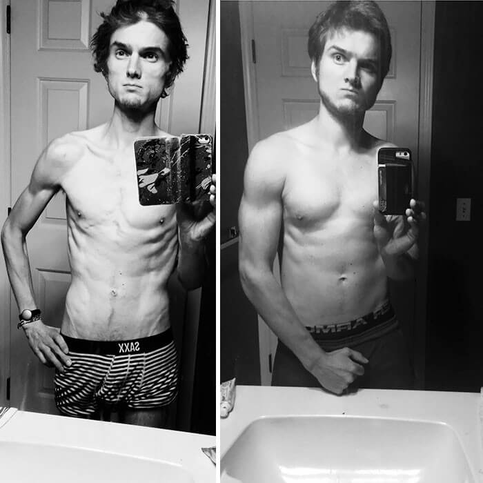 Anorexia Antes e Depois (32)