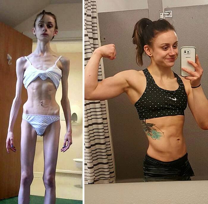 Anorexia Antes e Depois (4)