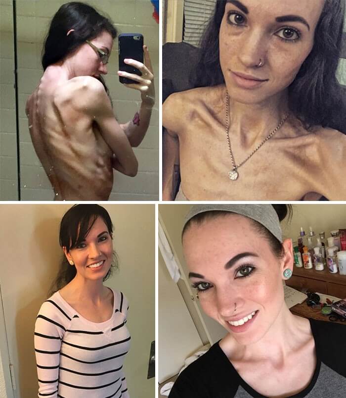 Anorexia Antes e Depois (40)