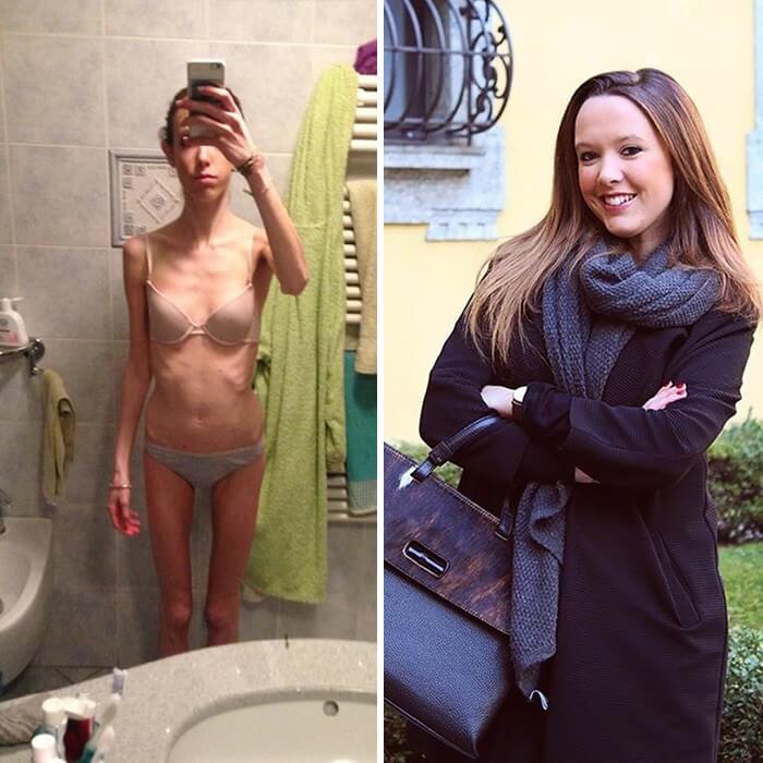 Anorexia Antes e Depois (47)