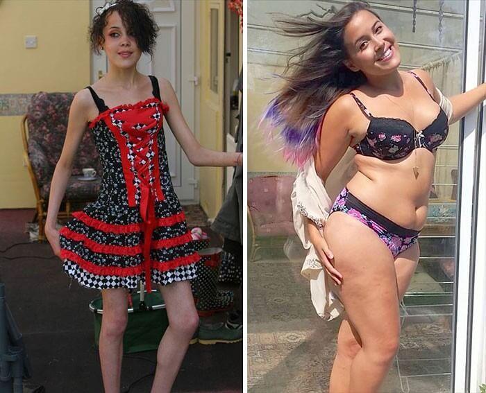 Anorexia Antes e Depois (9)