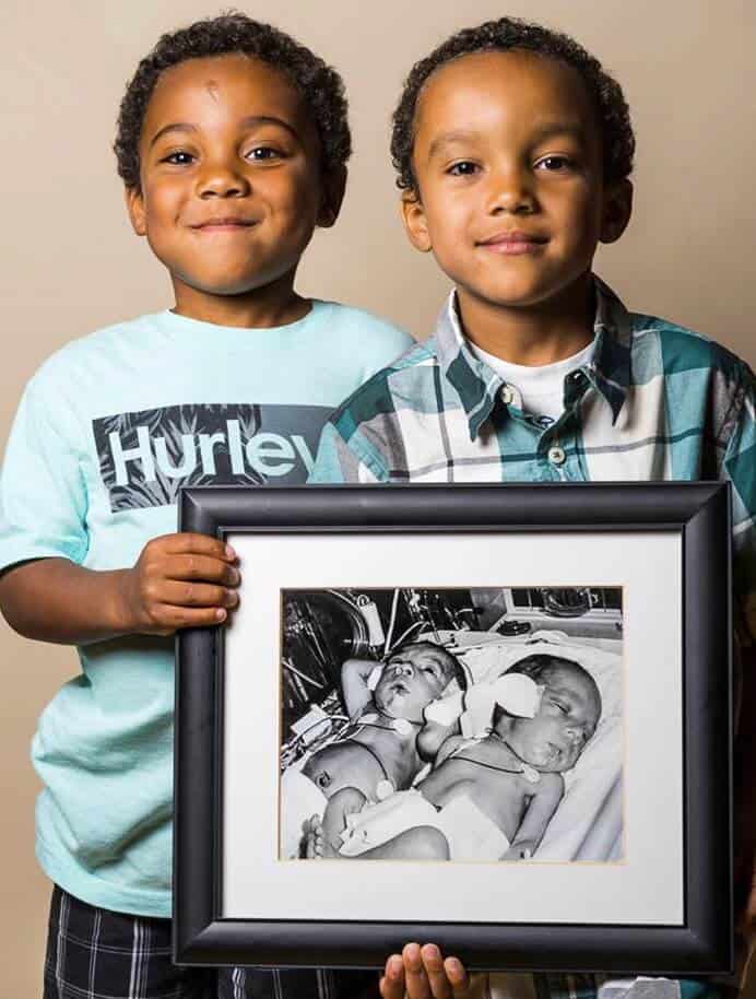 Fotógrafo mostra antes e depois de bebês prematuros e trabalho emociona fortemente