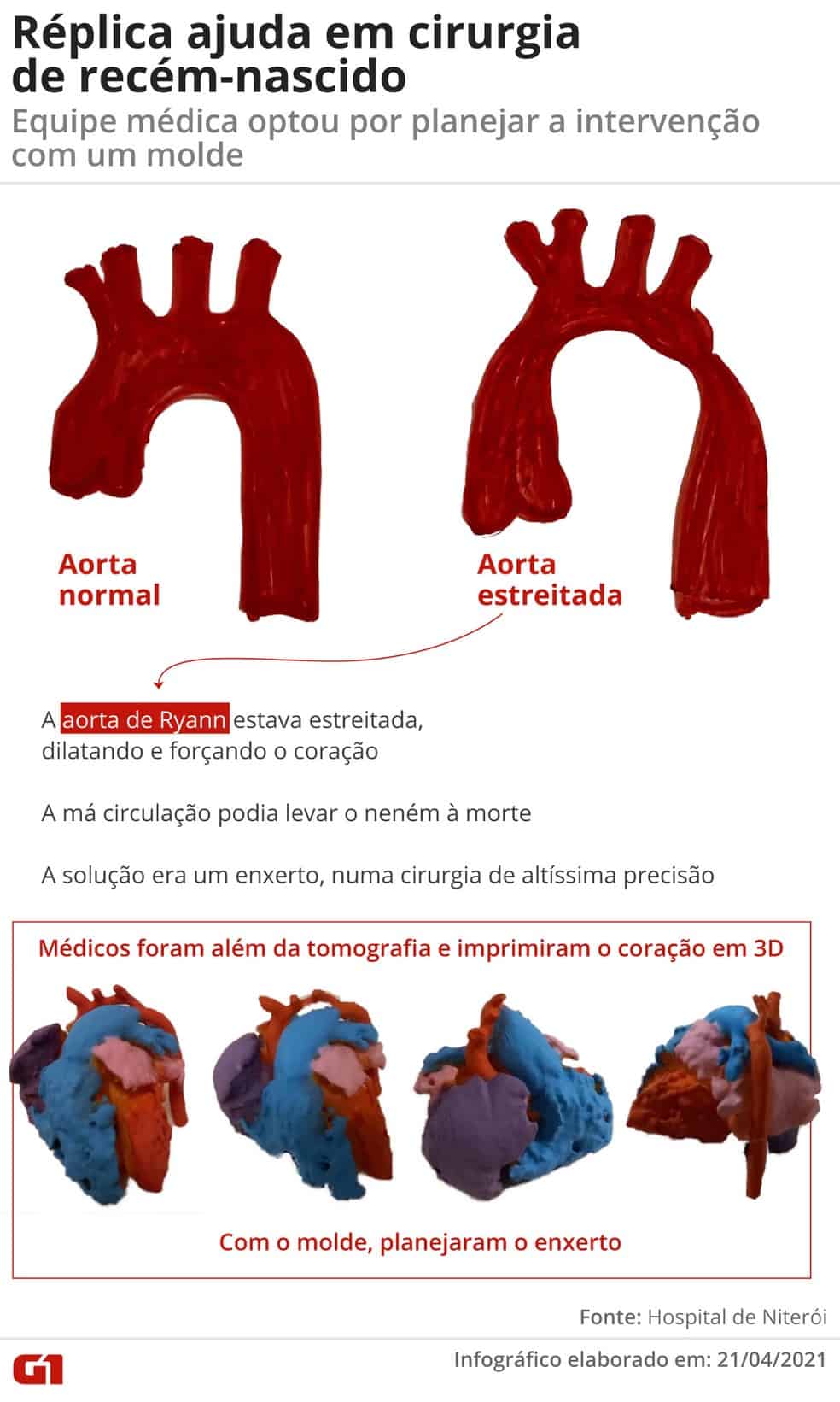 Médicos salvam vida de recém-nascido com uma impressão 3D