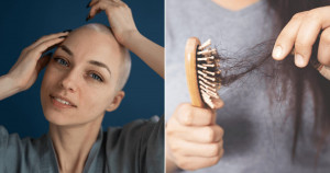 Esses sintomas emocionais podem indicar ALOPECIA e muita gente nunca soube