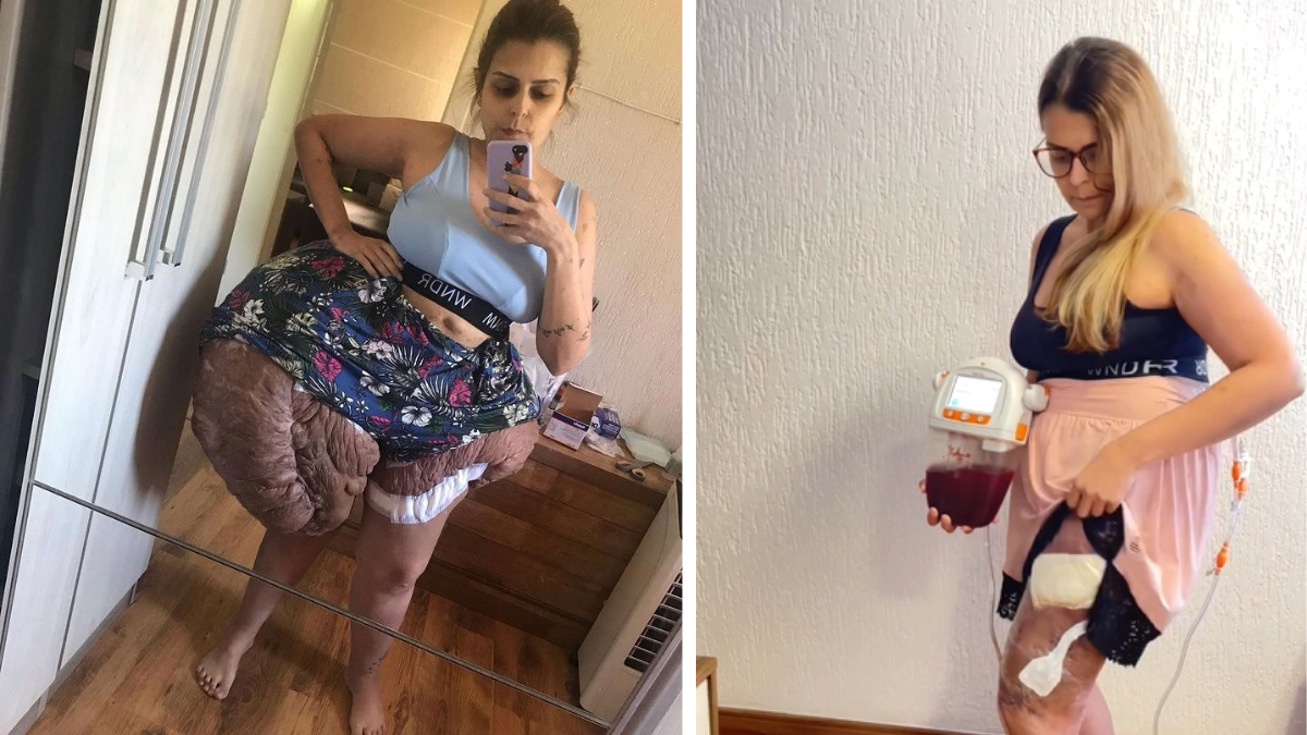 Recomeço: Após vaquinha online, jovem faz cirurgia para remover tumor com mais de 30kg