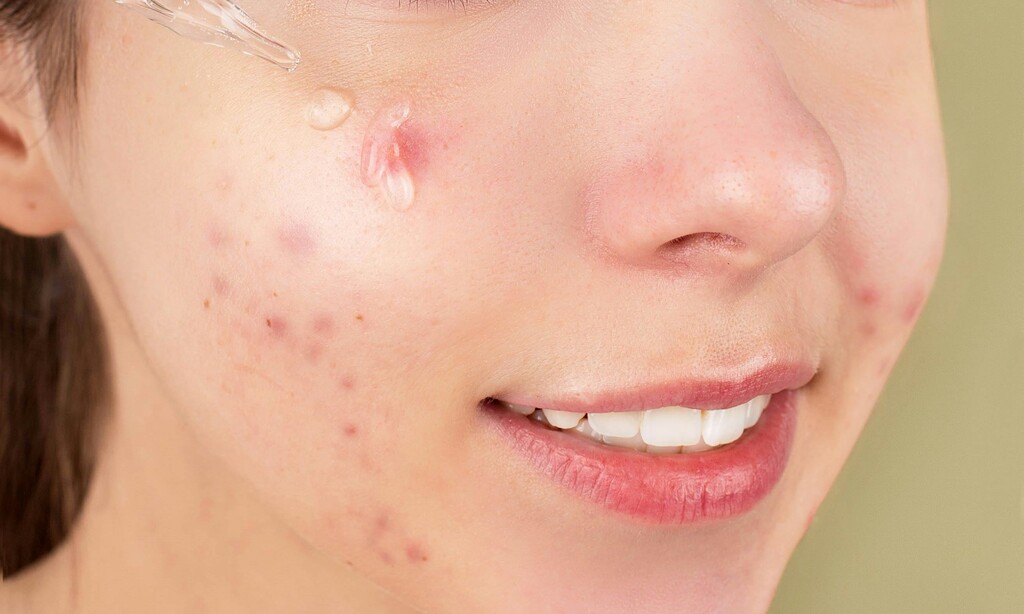 rotinas-de-skincare-que-realmente-funcionam-para-tratamento-acnes